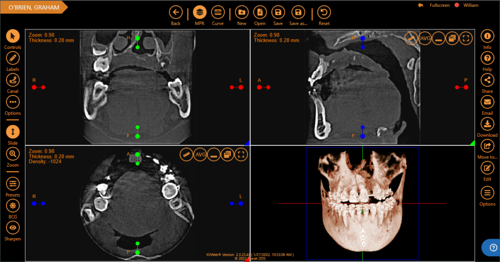 Screenshot of four 3D modules of a jaw in XVWeb