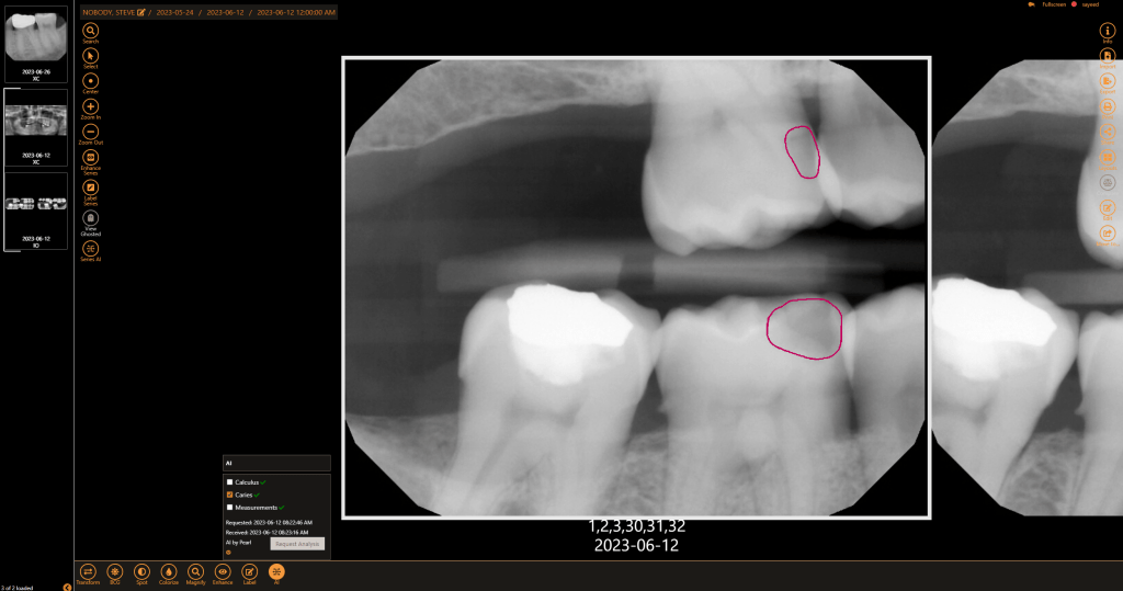 AI Digital Imaging Diagnosing Decay