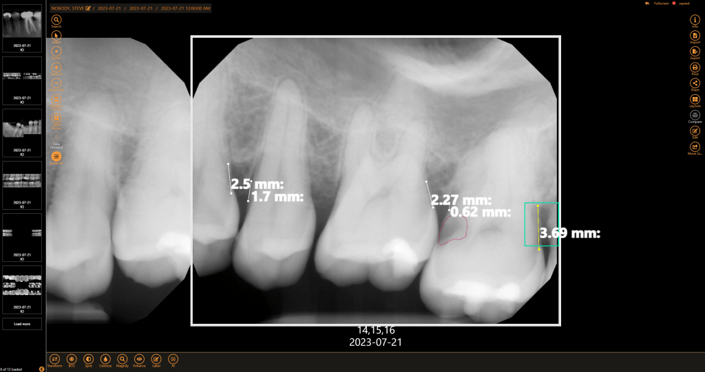 Get a second opinion to help diagnose decay, identify tarter build-up, and highlight bone levels to assist in diagnosing periodontal disease.