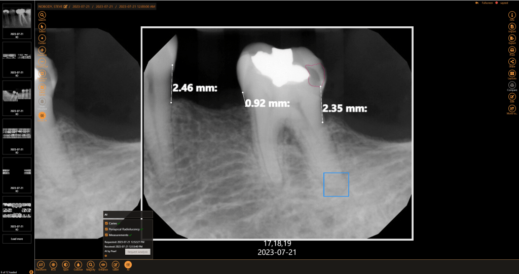 Periapical Radiolucency AI X-ray